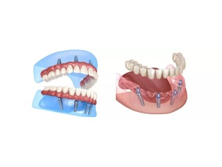 Full Mouth Dental Implants Melbourne