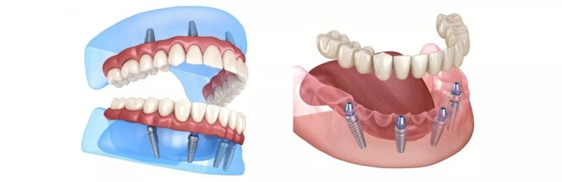 full-mouth-dental-implants-melbourne-big-0
