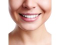 family-cosmetic-dentistry-in-beaumaris-bc-dental-small-1