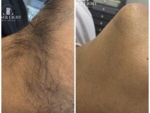 laser-hair-removal-east-london