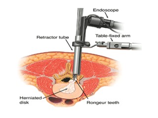 Best Spine Surgoen in Noida