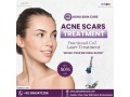 acne-scars-skin-care-hospital-in-bhubaneswar-best-skin-doctor-in-bhubaneswar-small-0
