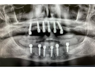 Gum surgery in Tijuana