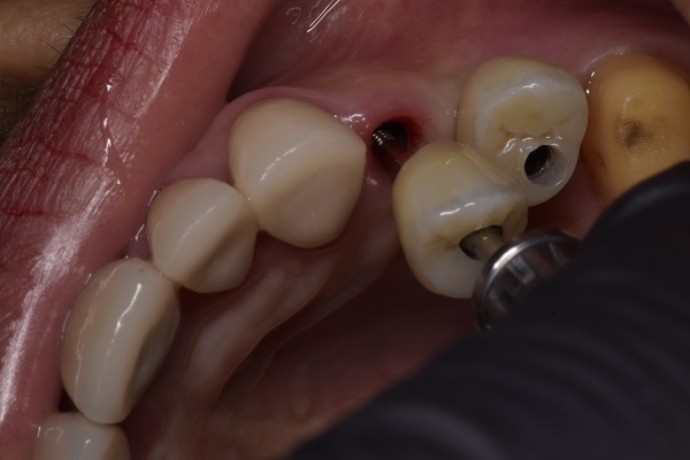 dental-implants-tijuana-offers-natural-looking-and-durable-teeth-replacements-big-0