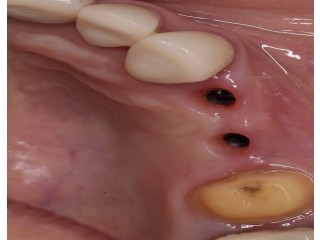 Revive your natural and flawless smiles with holistic Dental care in Tijuana
