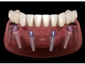 all-on-4-dental-implants-in-tijuana-mexico-affordable-life-changing-results-small-0