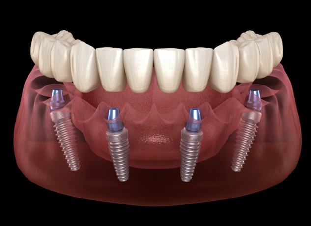 all-on-4-dental-implants-in-tijuana-mexico-affordable-life-changing-results-big-0