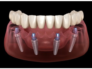 All-on-4 Dental Implants in Tijuana, Mexico – Affordable, Life-Changing Results!
