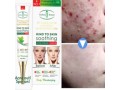 acne-freckle-cream-in-pakistan-medicated-cream-for-freckles-aichun-beauty-03000479274-small-0
