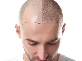 best-hair-replacement