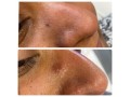 laser-removal-of-skin-tag-small-0