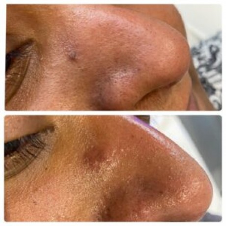 laser-removal-of-skin-tag-big-0