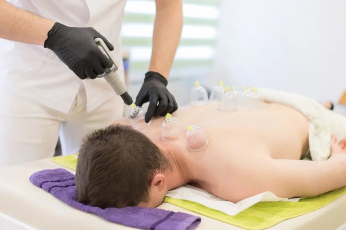 cupping-in-chicago-big-0