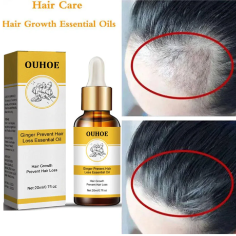 ouhoe-ginger-prevent-hair-loss-essential-oil-in-pakistan-wellmart-923208727951-big-0