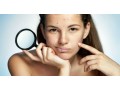 acne-orlando-small-0