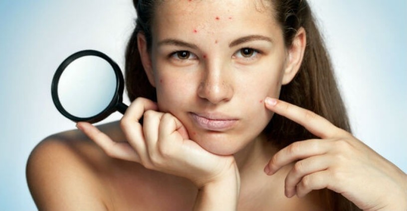 acne-orlando-big-0