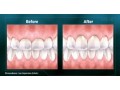 summerlin-dental-care-offers-advanced-laser-dentistry-that-can-transform-your-smile-small-0