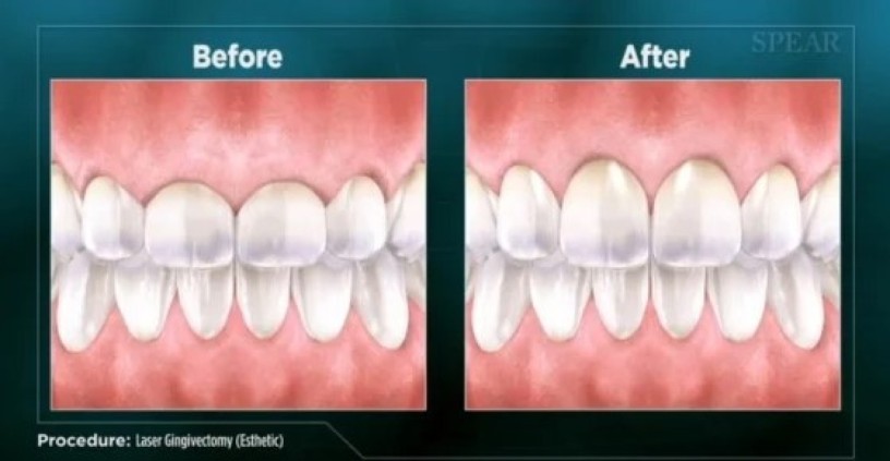 summerlin-dental-care-offers-advanced-laser-dentistry-that-can-transform-your-smile-big-0