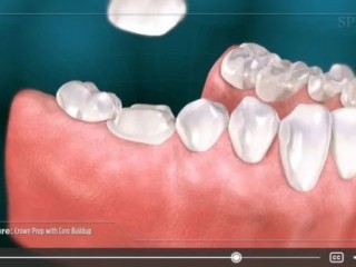 restore-your-smile-with-dental-implants-in-summerlin