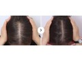 best-hairloss-treatment-dallas-small-0