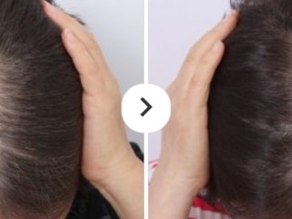 best-hairloss-treatment-dallas