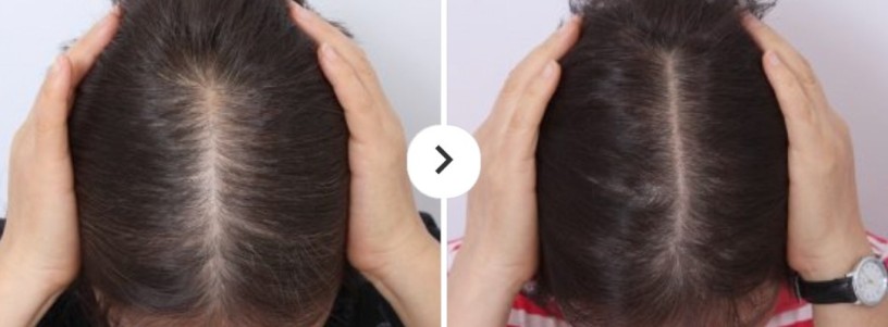 best-hairloss-treatment-dallas-big-0