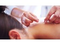 acupuncture-for-ivf-support-small-0