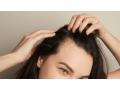 non-surgical-hair-dallas-small-0