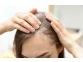 dallas-hair-loss-solutions-small-0