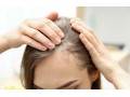 dallas-hair-loss-solutions-small-0