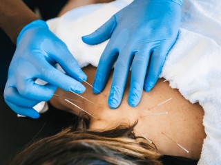 dry-needling-therapy-nyc