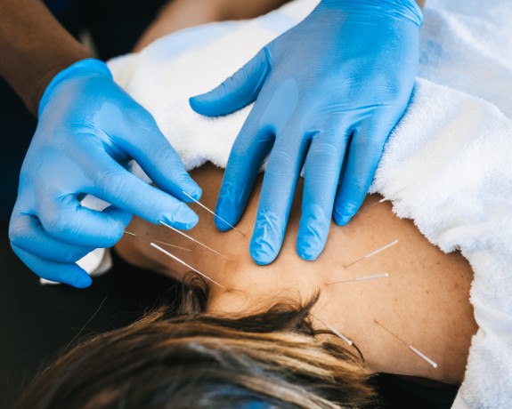 dry-needling-therapy-nyc-big-0