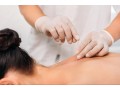 dry-needling-nyc-small-0
