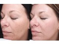 ipl-intense-pulsed-light-small-0