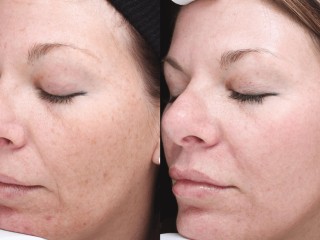 ipl-intense-pulsed-light