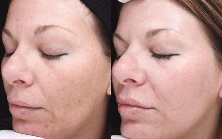 ipl-intense-pulsed-light-big-0