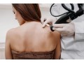 fractionated-co2-laser-for-acne-scars-pigmentation-in-altamonte-springs-orlando-daytona-beach-clermont-small-0
