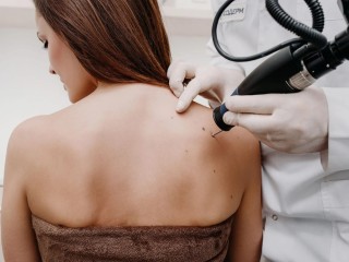 fractionated-co2-laser-for-acne-scars-pigmentation-in-altamonte-springs-orlando-daytona-beach-clermont